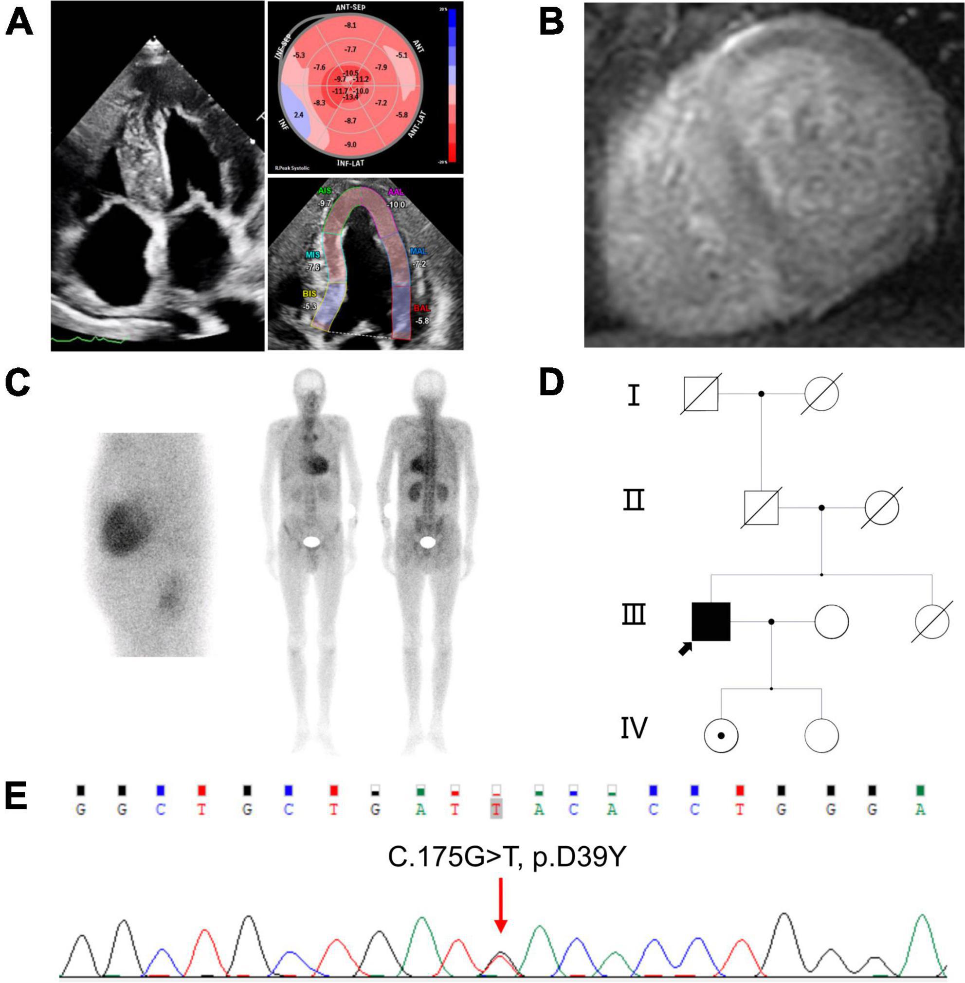 Identification of a novel transthyretin mutation D39Y in a cardiac amyloidosis patient and its biochemical characterizations
